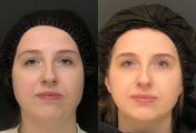 Контурная пластика скуловой и височной зоны