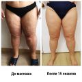 Результат после антицеллюлитного массажа бедер
