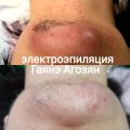 Удаление нежелательных волос, в том числе седых и светлых.