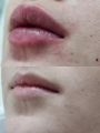 Филлеры-увеличение губ