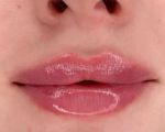 ? Губы могут иметь недостаточный объем, с возрастом меняется форма и цвет. С этой проблемой легко справиться процедура по заполнению губ филлером с гелауроновой кислотой. 
       Использую  сверхчистые инъекционные препараты на основе гиалуроновой кислоты V поколения способные создать форму, придать яркость цвета и разгладить морщины. 