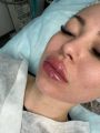 Выполнена коррекция губ препаратом на основе натуральной Гиалуроновой Кислоты