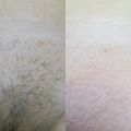 Шугаринг глубокого бикини до и после процедуры.