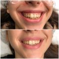 Лечение десневой улыбки