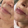 Увеличение губ 