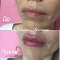 Контурная пластика губ 