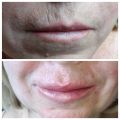 Увеличение губ 