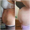 Коррекция локальных жировых отложений, целлюлита