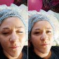 До и после гликолевого пилинга