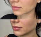 Контурная пластика подбородка
