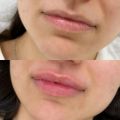 Контурная пластика губ (увеличение губ)