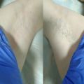 Депиляция подмышечных впадин, до и после