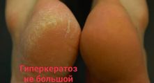 Обработка Гиперкератоза.
