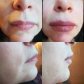 Заполнение губ,подбородка и морщин марианеток