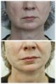 Коррекция овала лица-фото сразу после процедуры