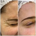 Коррекция мимических морщин в среднем на 4-6 мес.