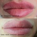 Удаление татуажа губ