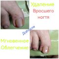 Удаление кусочков ногтей, которые доставляют дискомфорт