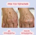 Prx t33 терапия
Работа с пигментацией кожи рук
Результат 5 процедур