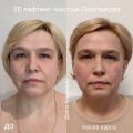 3D лифтинг–массаж Плотникова, 9 сеансов, 50 лет. 