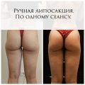 Ручная липосакция. Зона галифе.
