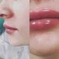 Увеличение губ на основе гиалуроновой кислоты! Полностью биодеградируем.