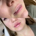 Коррекция губ от 7500руб. _cosmetology_