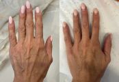 Восполнение утраченных обьемов на ручках. Это результат от 1 процедуры коллагенового омоложения. Рельеф сухожилий и вен стал менее заметный и , соответственно, руки выглядят более молодыми. Курс 3-4. 