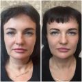 Омоложение точки молодости , углы Джоли , скулы