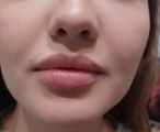 Добавлено немного объёма и оазвернула верхнюю и нижнюю губы, синяков практически не было 