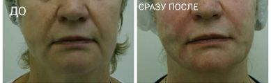 Нитевой лифтинг средней трети лица