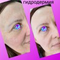 Гидродермия- аппаратная методика, лифтинг, увлажнение, проработка мышц