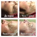 Проведён курс классического косметического массажа лица