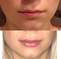 Коррекция формы губ препаратом Princess Filler