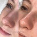Сочетание УЗ пилинг + вакуумный гидропилинг + механическая чистка лица + уходовая косметика + маска (по желанию)
Хочешь ощутить нежность и свежесть своей
кожи? Тогда тебе точно нужна услуга чистка лица!

Я вам предлагаю профессиональную чистку лица, которая поможет избавиться от чёрных точек, выравнить тон кожи и сделать её гладкой и сияющей. Чистка лица - это не только процедура для красоты, но и забота о здоровье кожи. ?

Перед проведением чистки лица проводится диагностика кожи, чтобы подобрать оптимальн