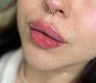 Коррекция губ 1мл филлера