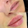 Контурная пластика губ