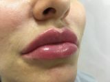 Увеличение губ ( Sardenya Deep