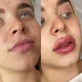Коррекция  губ от 7500руб.