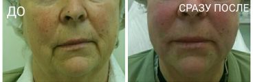 Нитевой лифтинг средней трети лица