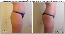 Антицеллюлитный массаж, курс 10 сеансов