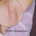 После процедуры