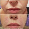 Коррекция носогубных морщин 