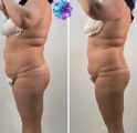 За 1 сеанс -5 см в объеме живота 