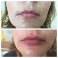 коррекция губ