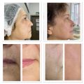 Комплексная программа :
-микротоковая терапия (2 раза )
-пилинг -лосьон( 10 % pH4,0) Ultra Peel
-комплекс Anti Age ( 60 мин )