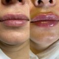 Контурная пластика губ, итальянскими филлерами IFiller promoitalia