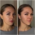 Углы Джоли , коррекция подбородка