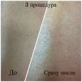 3 процедура. Волос уже значительно меньше. Сразу после может быть покраснение. 