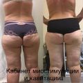 Миостимуляция ( 20 электродов)